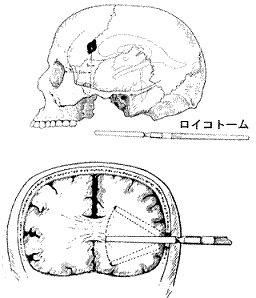 シャッターアイランド,前頭葉ロボトミー手術の仕方（Freeman,W.&Watts,J.Psychosurgery 1942,Charles C.Thomas）.gif